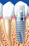 インプラント